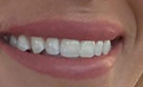 Person smiling, showing teeth and lips.